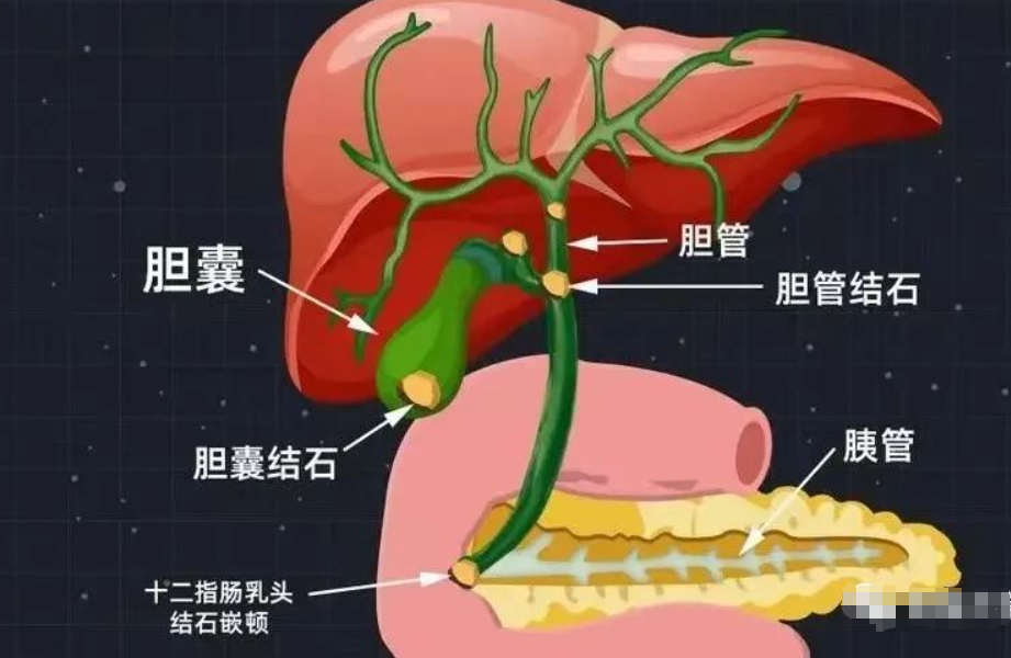 45岁武慧珍患胆囊胆总管结石,3个月坚持方法,医生:恢复太理想