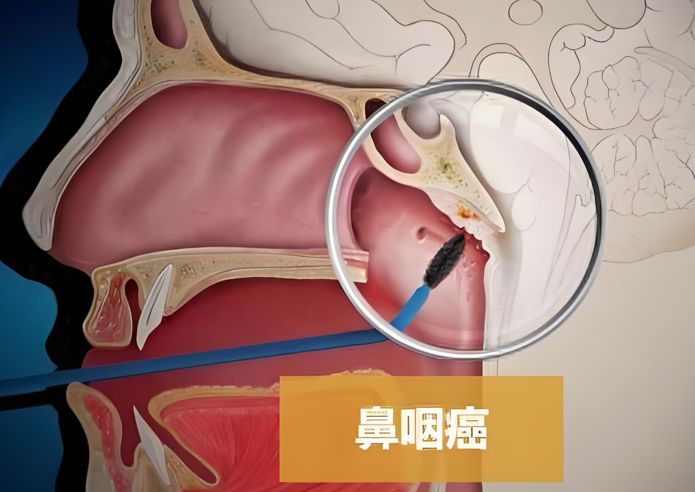 48岁男子确诊鼻咽癌,医生:有这3个原因,很多人都没注意