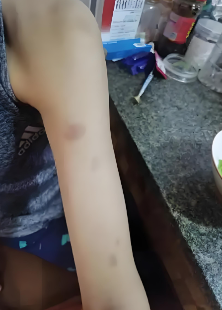 回顾:22岁女生因白血病不幸去世,从确诊到去世仅5个多月,曾称身上出现