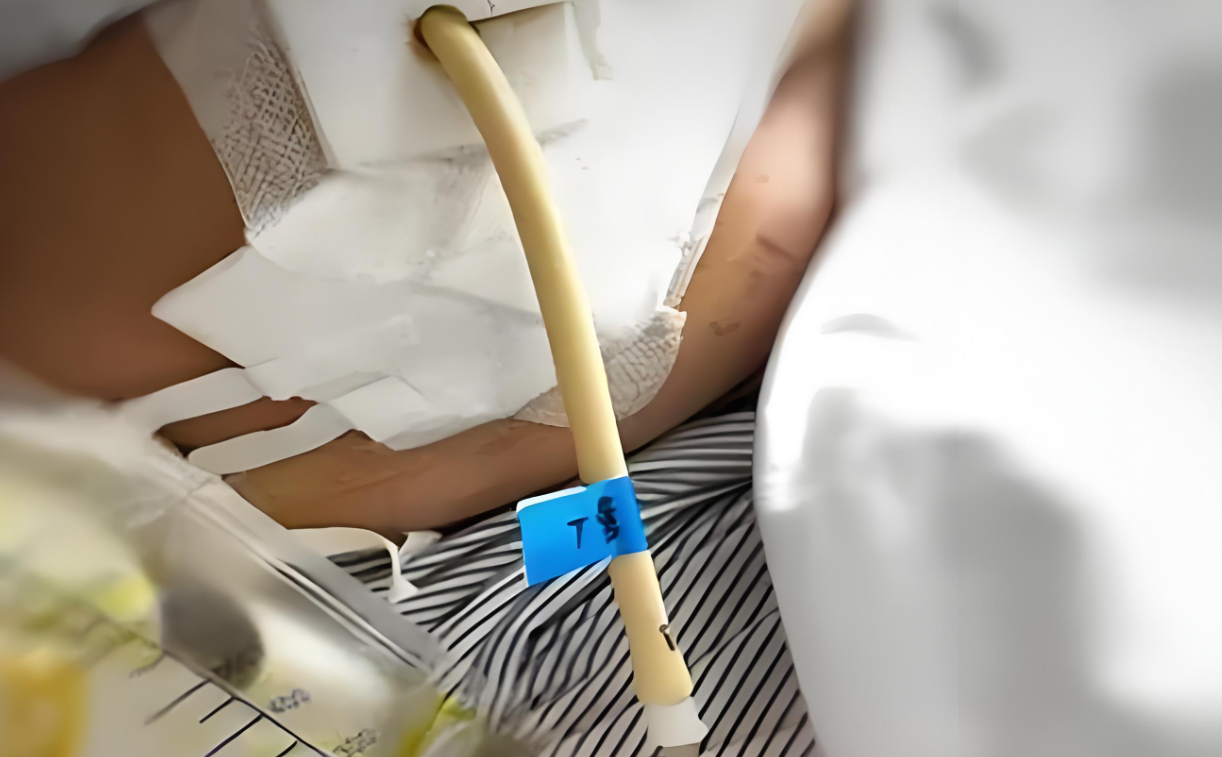 肺癌手术后,胸腔插管带着引流袋,生命还能延续几年?医生来回应