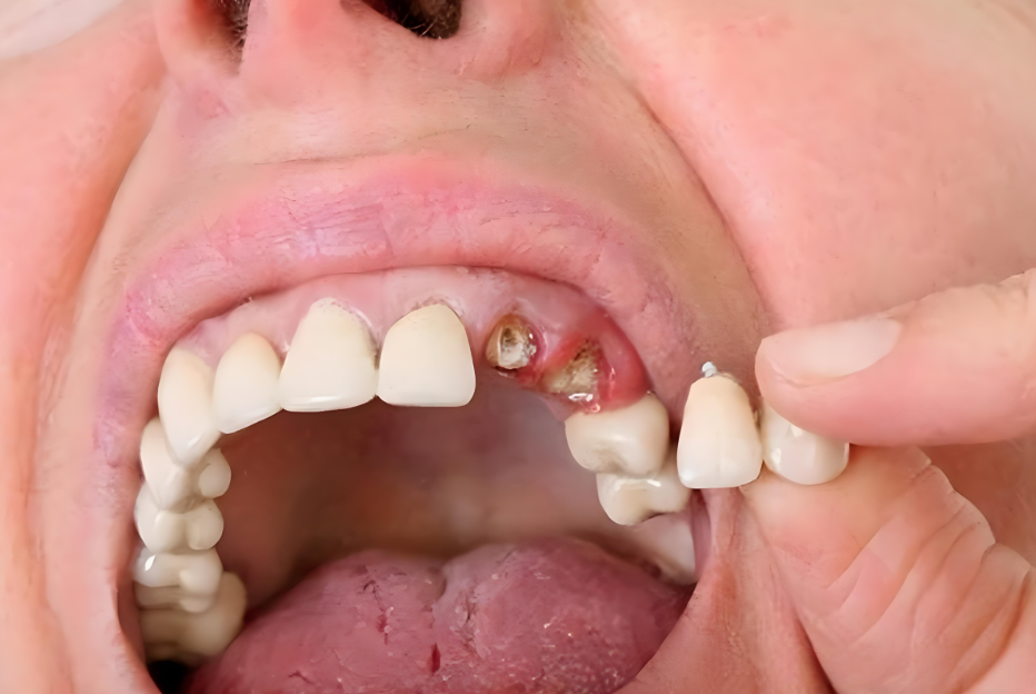 老年人通常几岁开始出现牙齿脱落?牙齿脱落后应注意哪些事项?