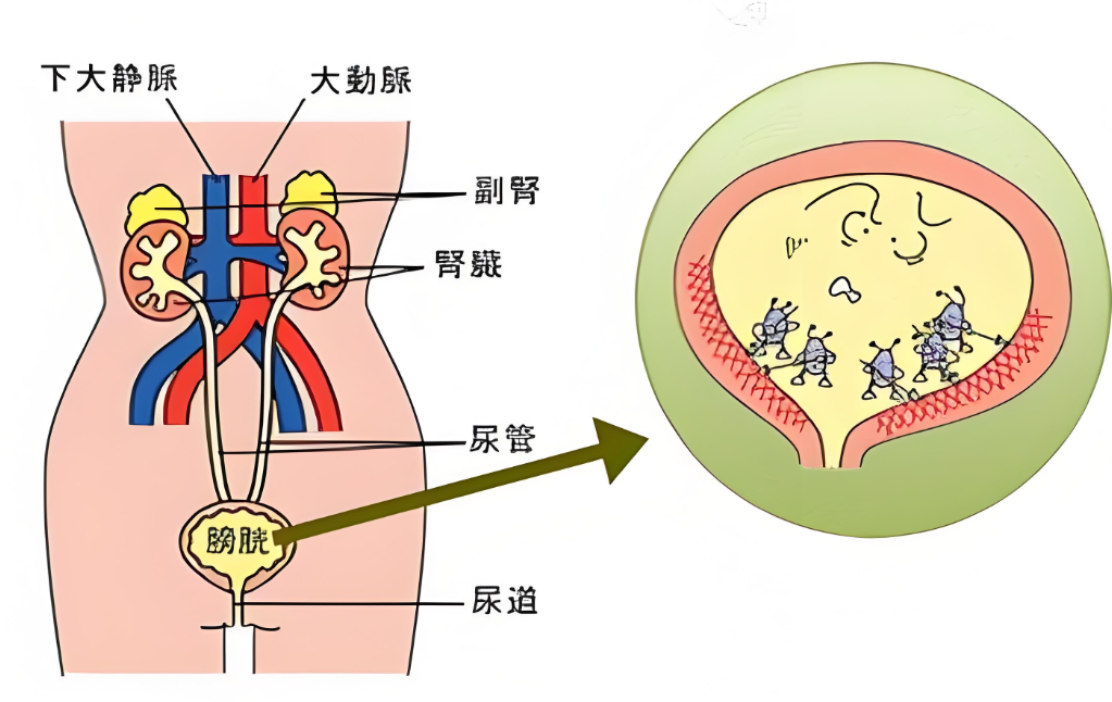 45岁男子吃左氧氟沙星治膀胱炎,在用药之前,要先了解用药误区