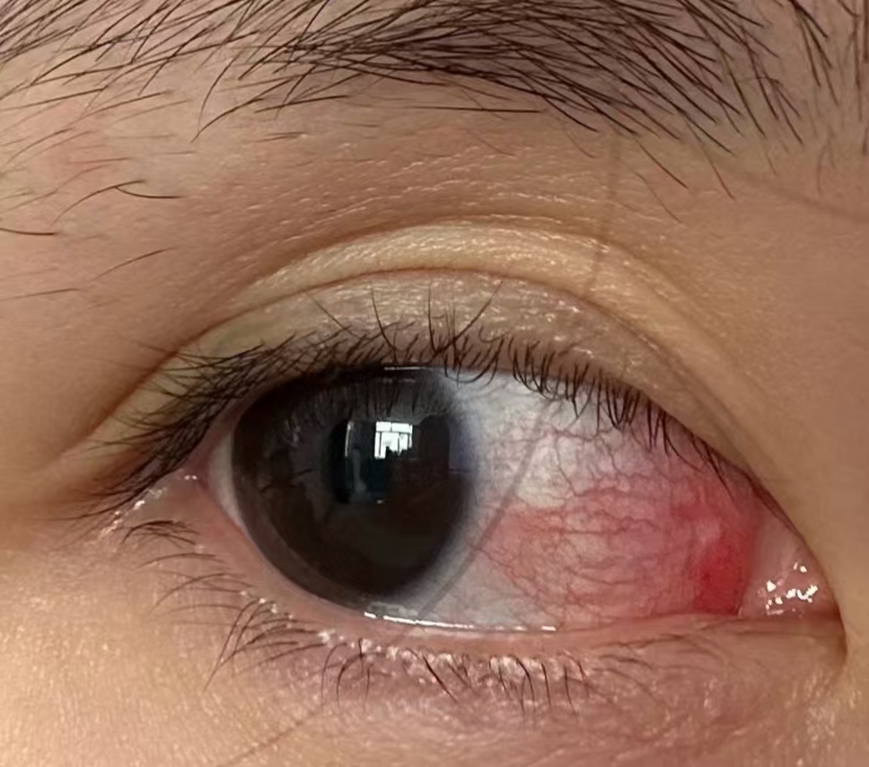 8岁儿童频繁揉眼畏光1个月,医生解析翼状胬肉早期3个信号