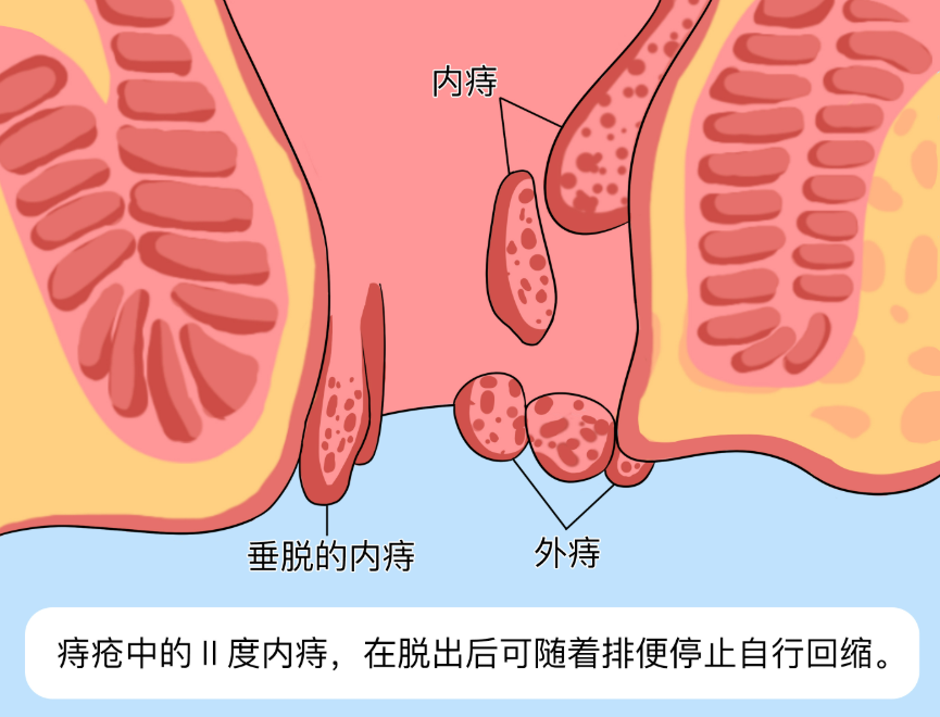 怎样分辨是不是痔疮图片