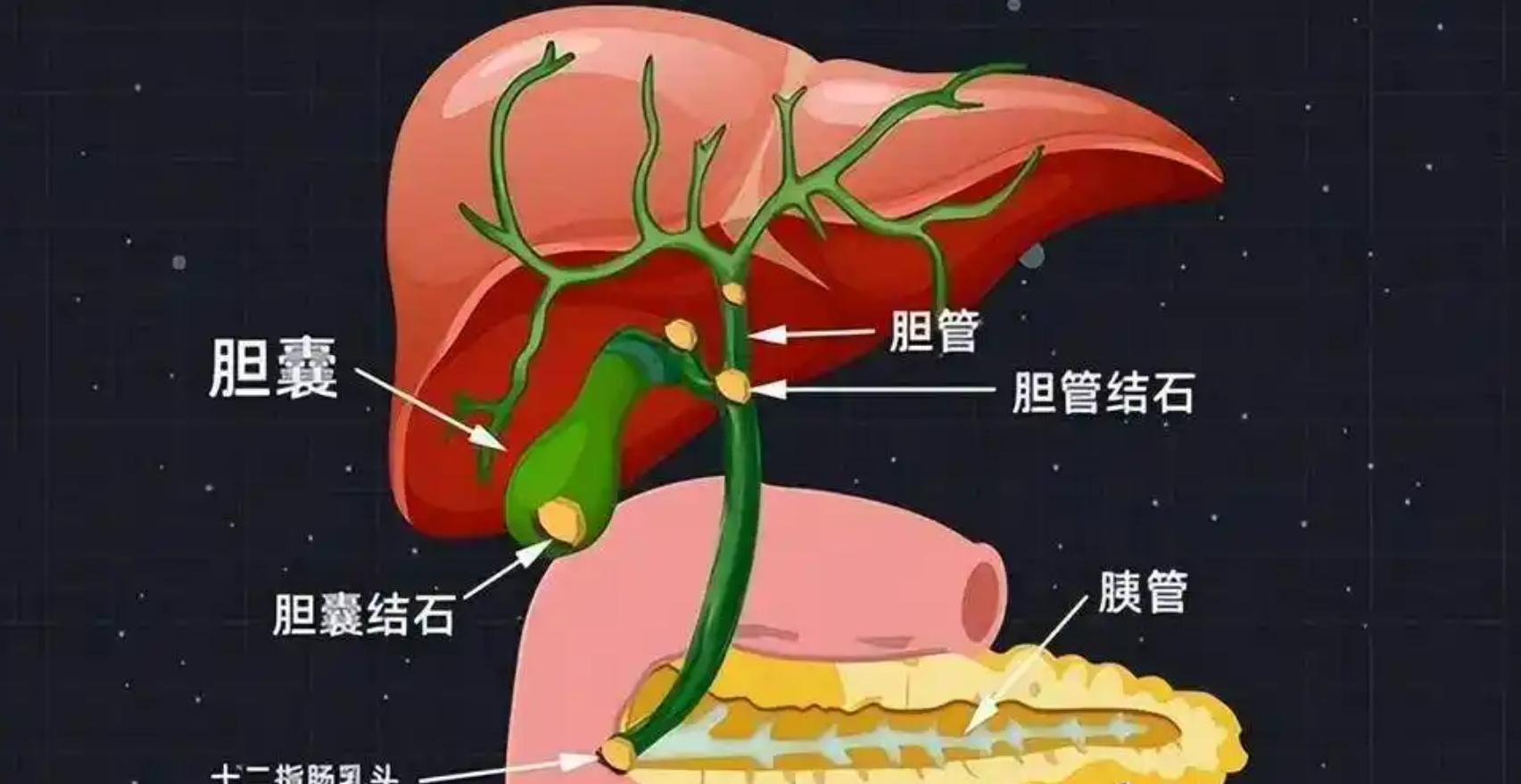 41岁女子胆结石,2年后转癌,三个原因清晰可见