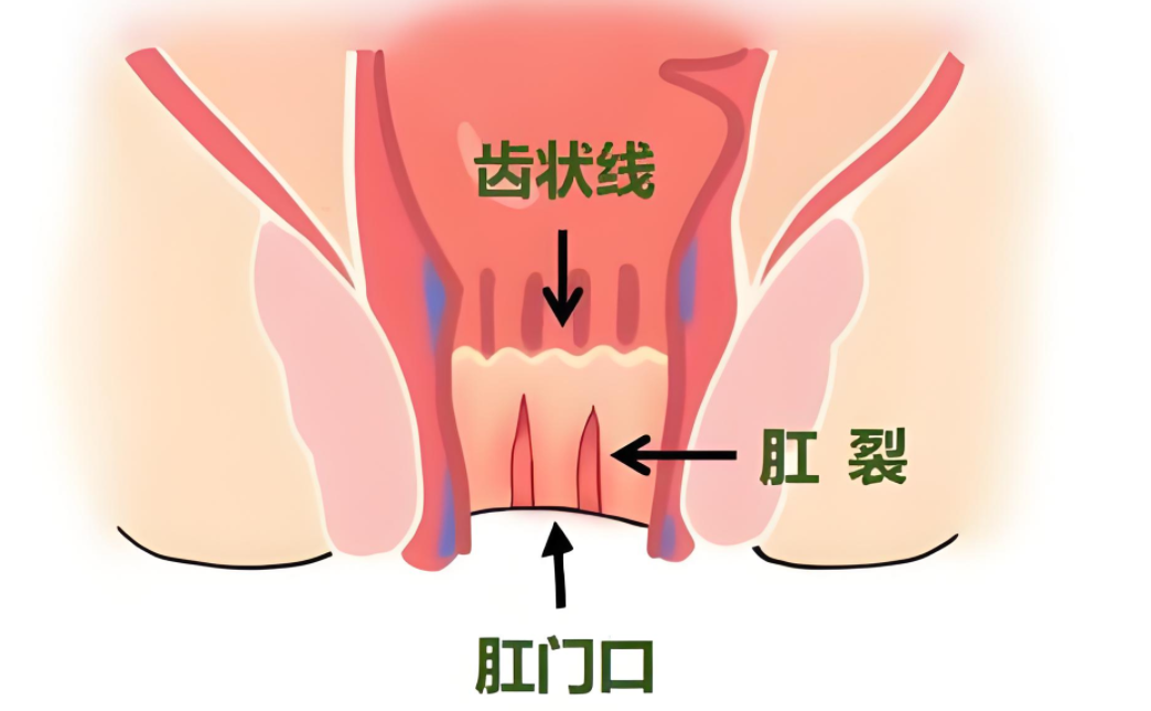 32岁男子肛裂用多磺酸粘多糖乳膏,163天后诱发脓毒血症,咋回事