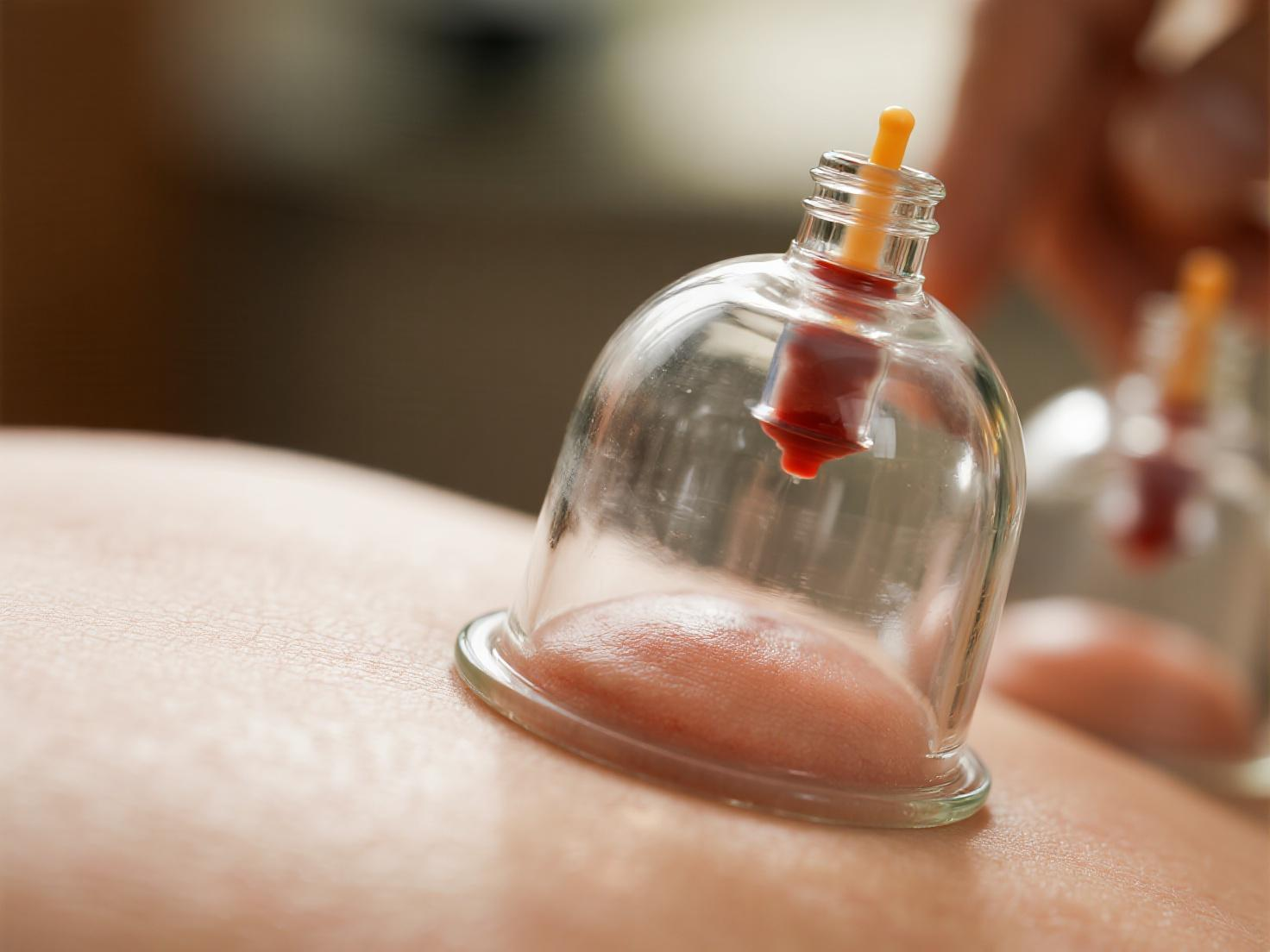 三伏将至,家中拔罐祛湿正当时!掌握几穴,轻松应对湿气困扰