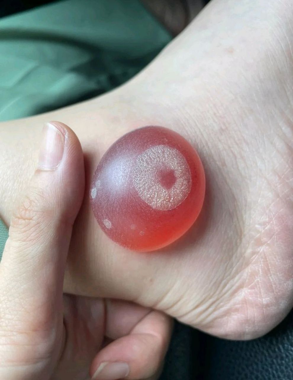 网友:脚上长个大血泡,严重不严重啊,要不要去医院?#百家号星火计划