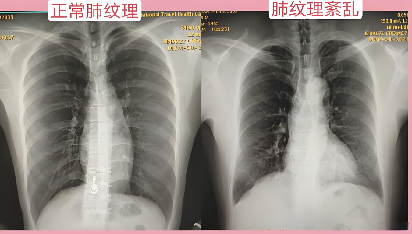 16年,浙江38岁男子患慢阻肺,医生:日常做好2点,避免病情加重