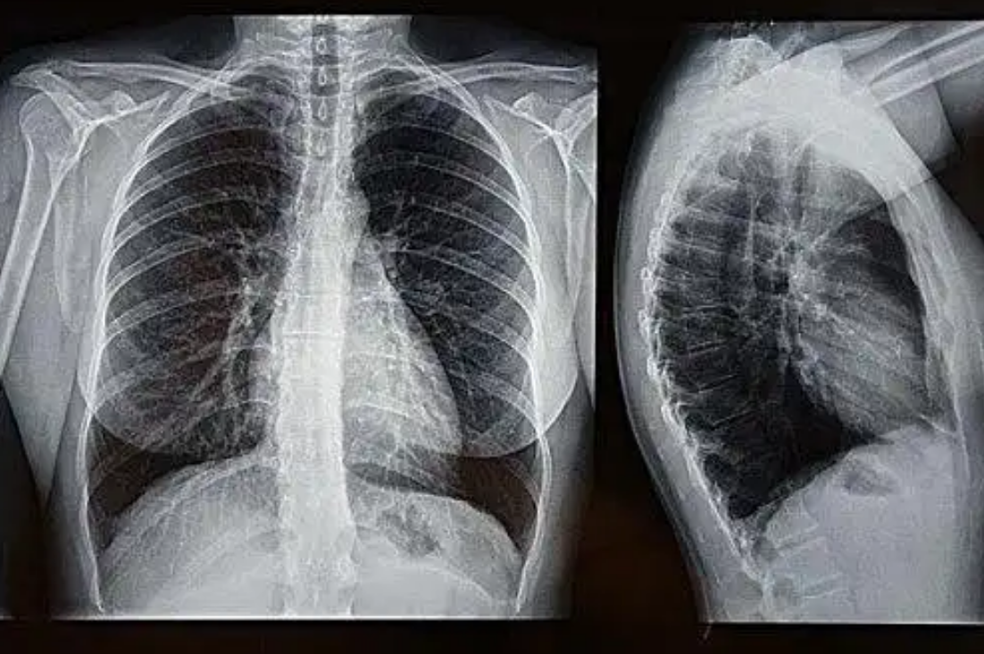 纪实:53岁女子查出肺结核,每天坚持锻炼,半年后复查结果如何