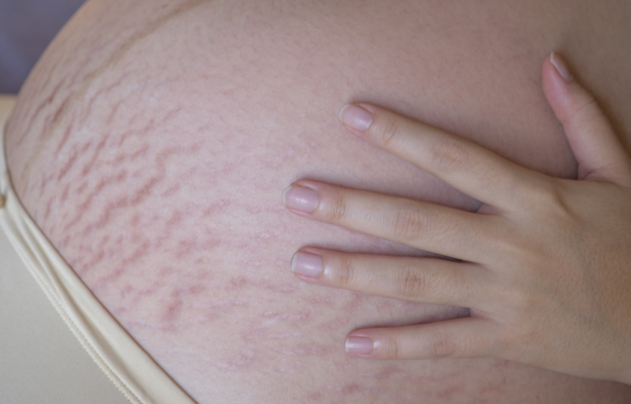 预防妊娠纹指南 皮肤科主任提醒:3个误区毁掉肚皮 90%孕妈不知道