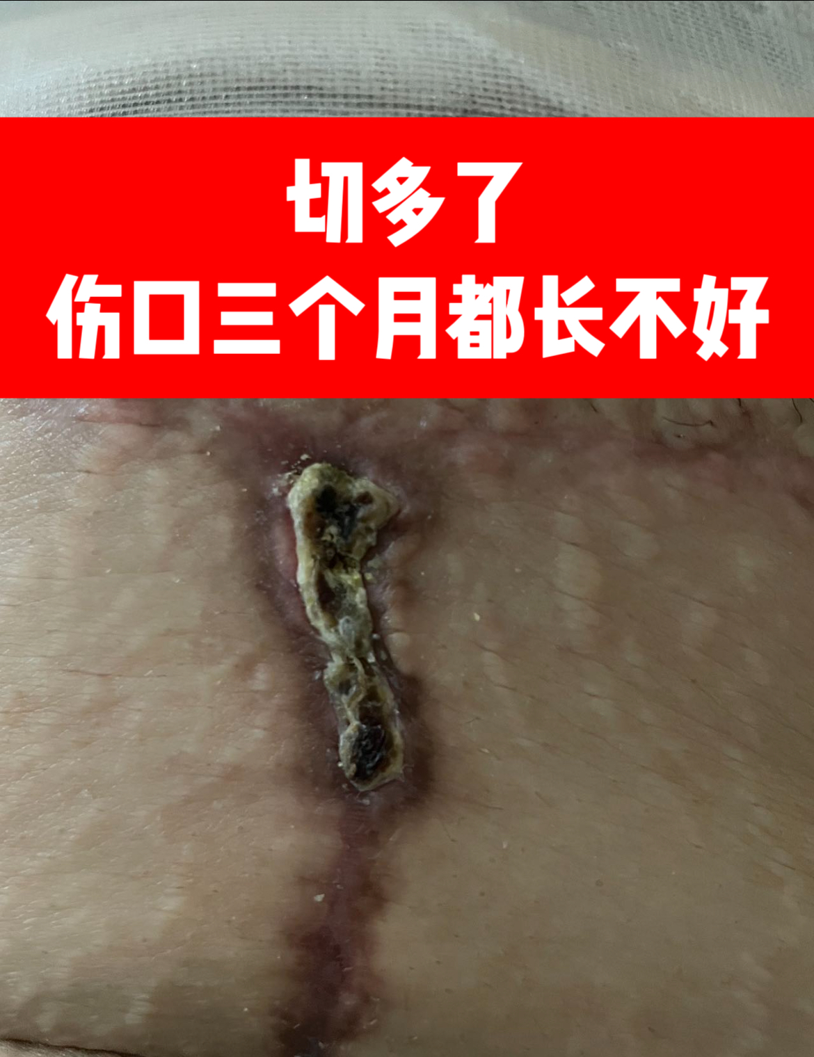 全腹壁整形术体验