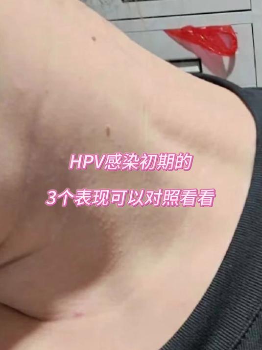 hpv感染初期的3个表现,可以对照看看
