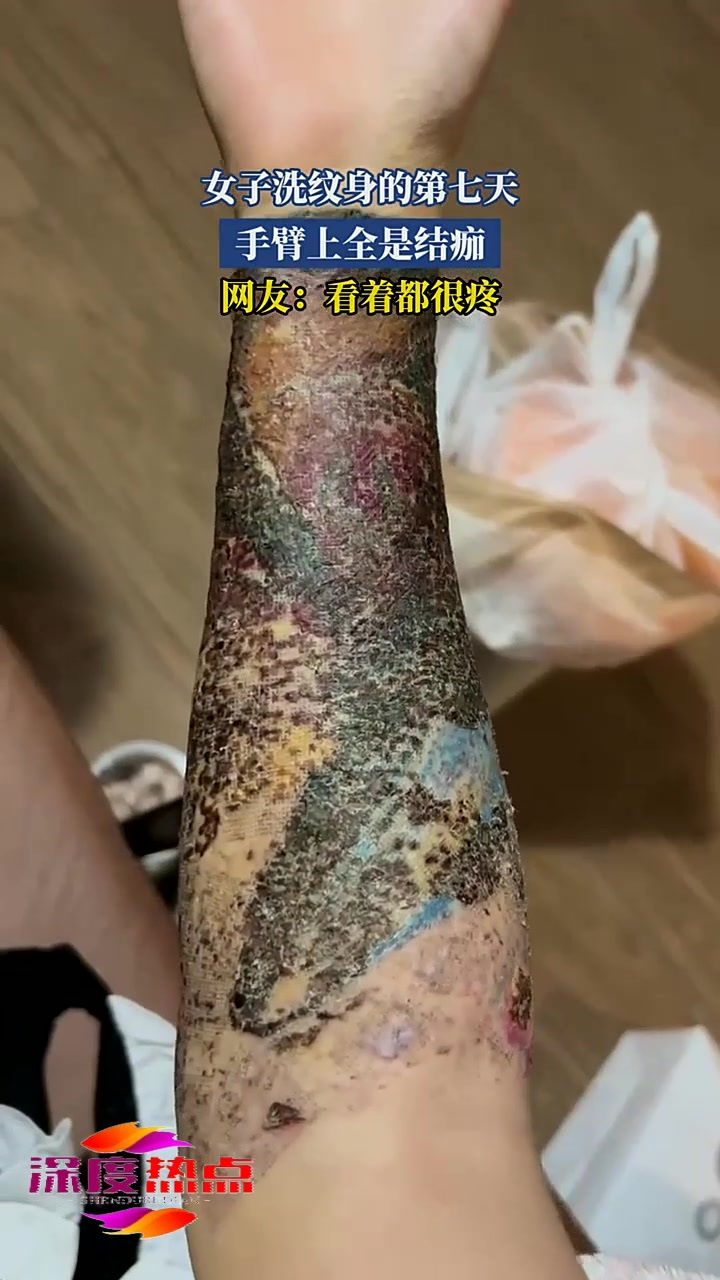女子洗纹身的第七天,手臂上全是结痂看着都很疼