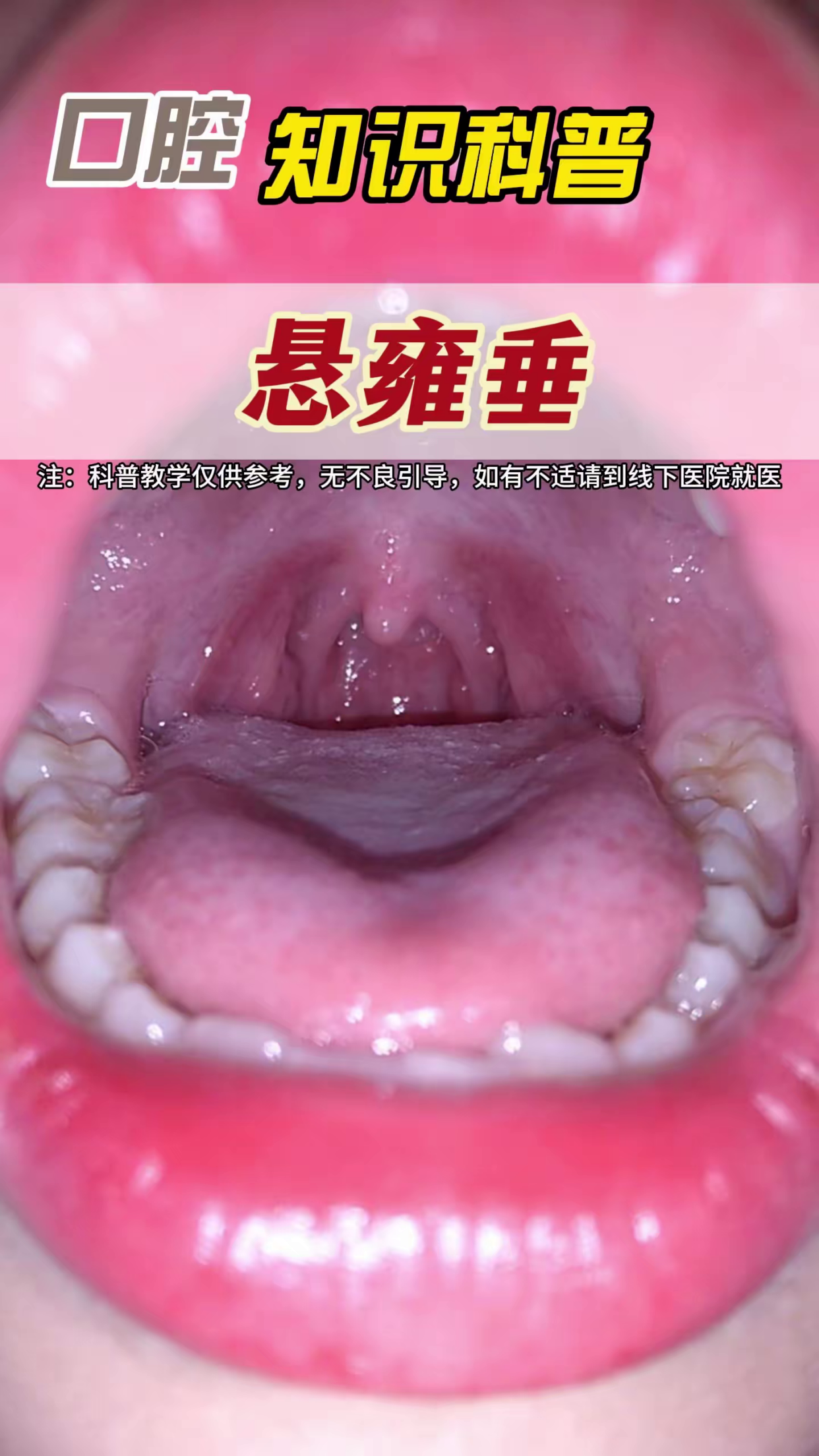 口腔知识科普悬雍垂