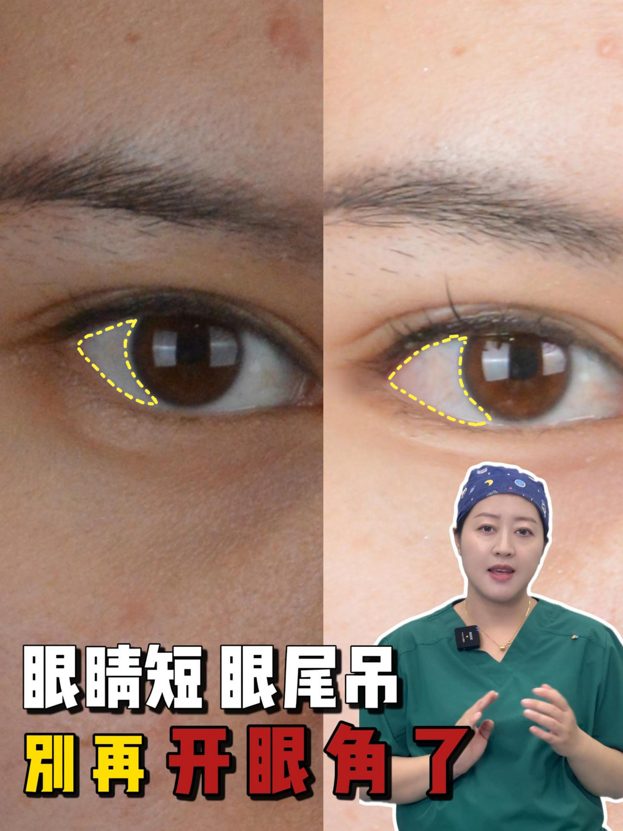 眼睛短,眼尾吊,别再开外眼角了