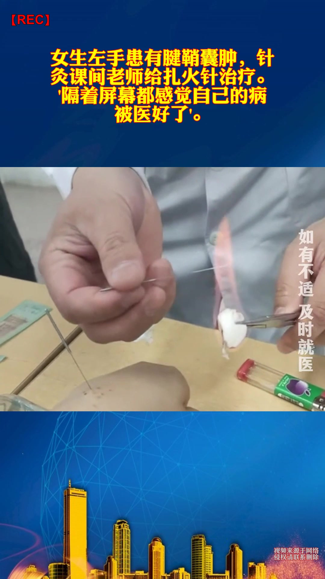 女生左手患有腱鞘囊肿,针灸课间老师给扎火针治疗.隔着屏幕都