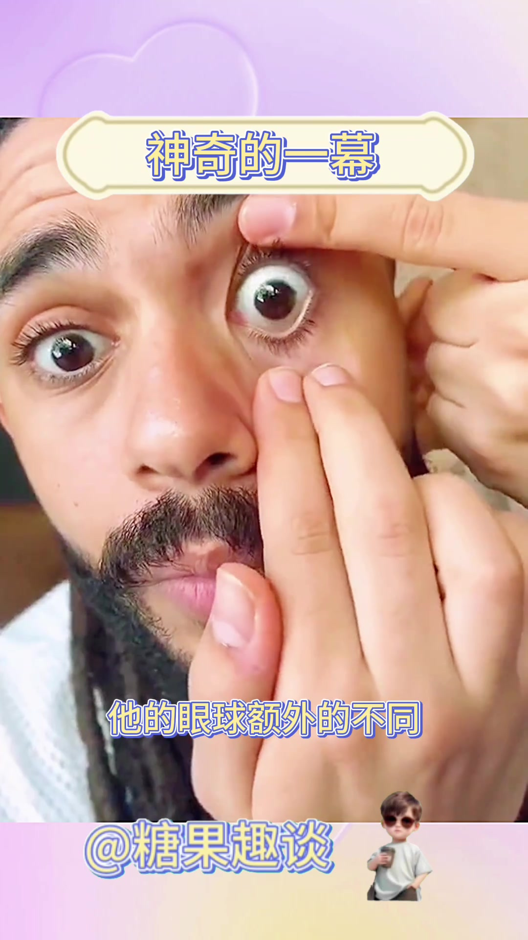 国外男子眼球惊现双黑眼珠,真是奇妙世界的另类景观!