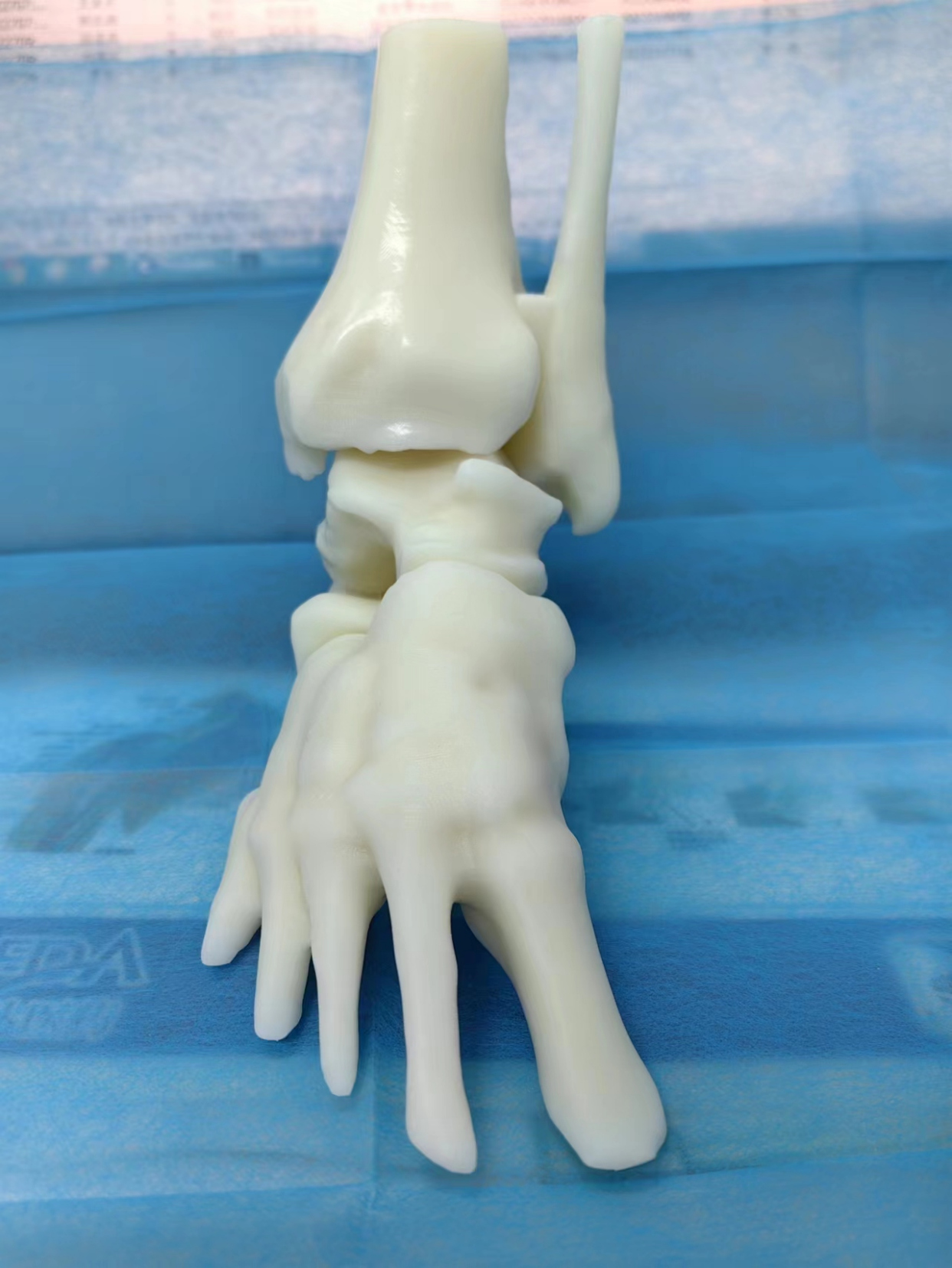 北京市隆福医院骨二科完成首例国产个性化定制人工全踝关节置换术