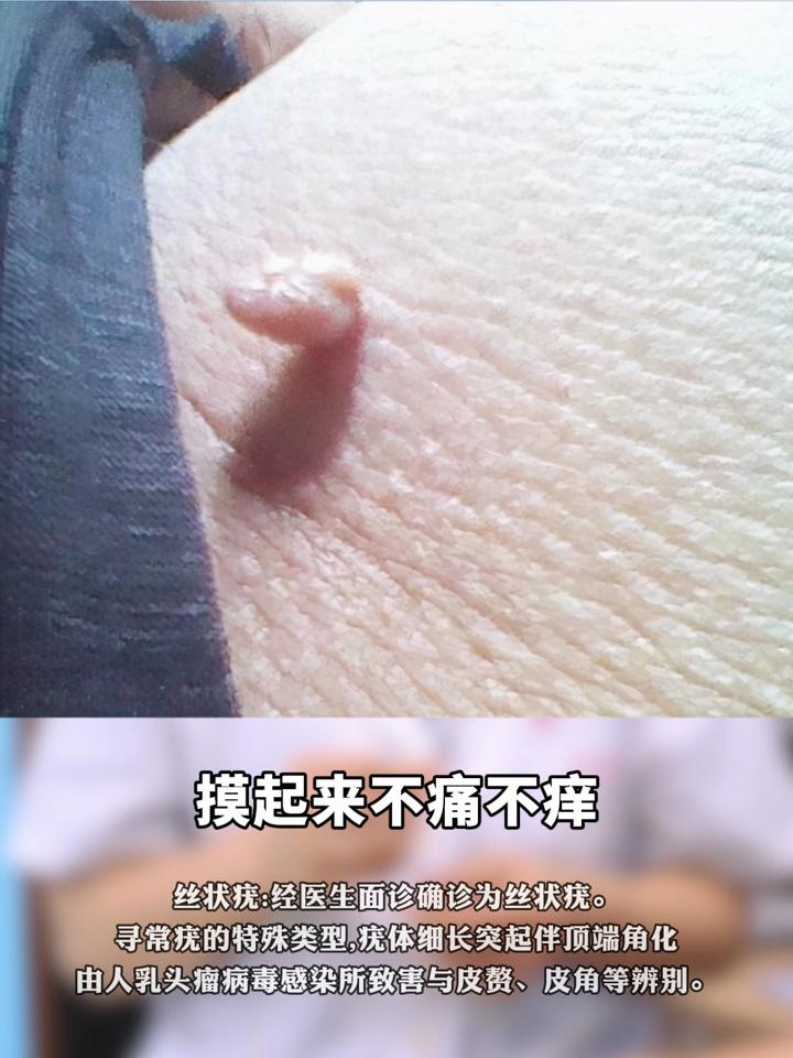 男性hpv什么症状图片