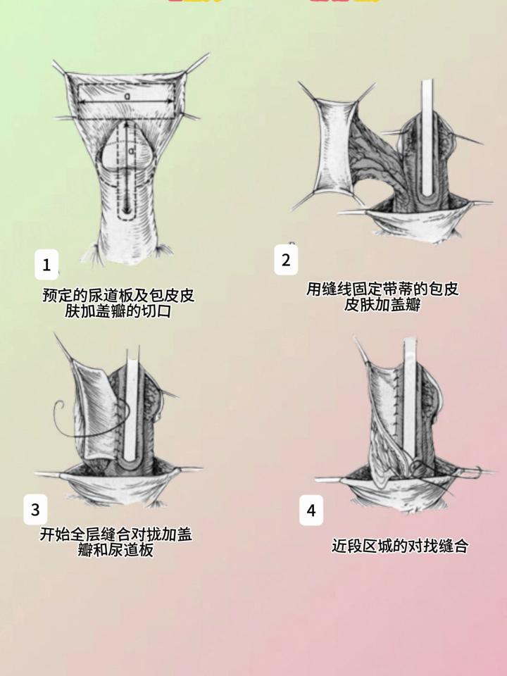 岛状皮瓣示意图图片