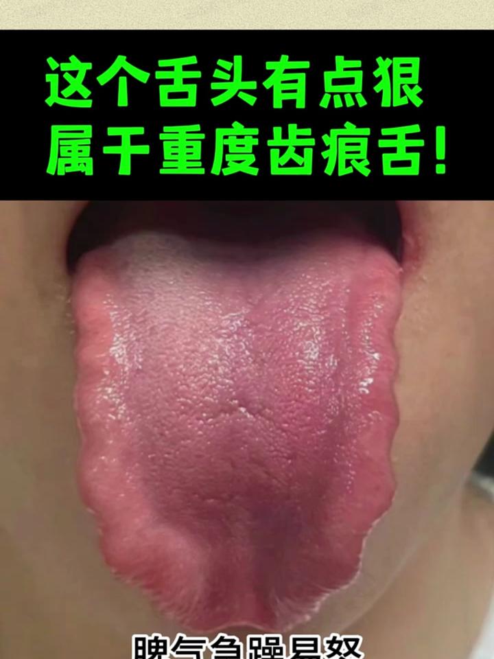 典型的重度齿痕舌,舌头周边全是齿痕印,该怎么调理呢?