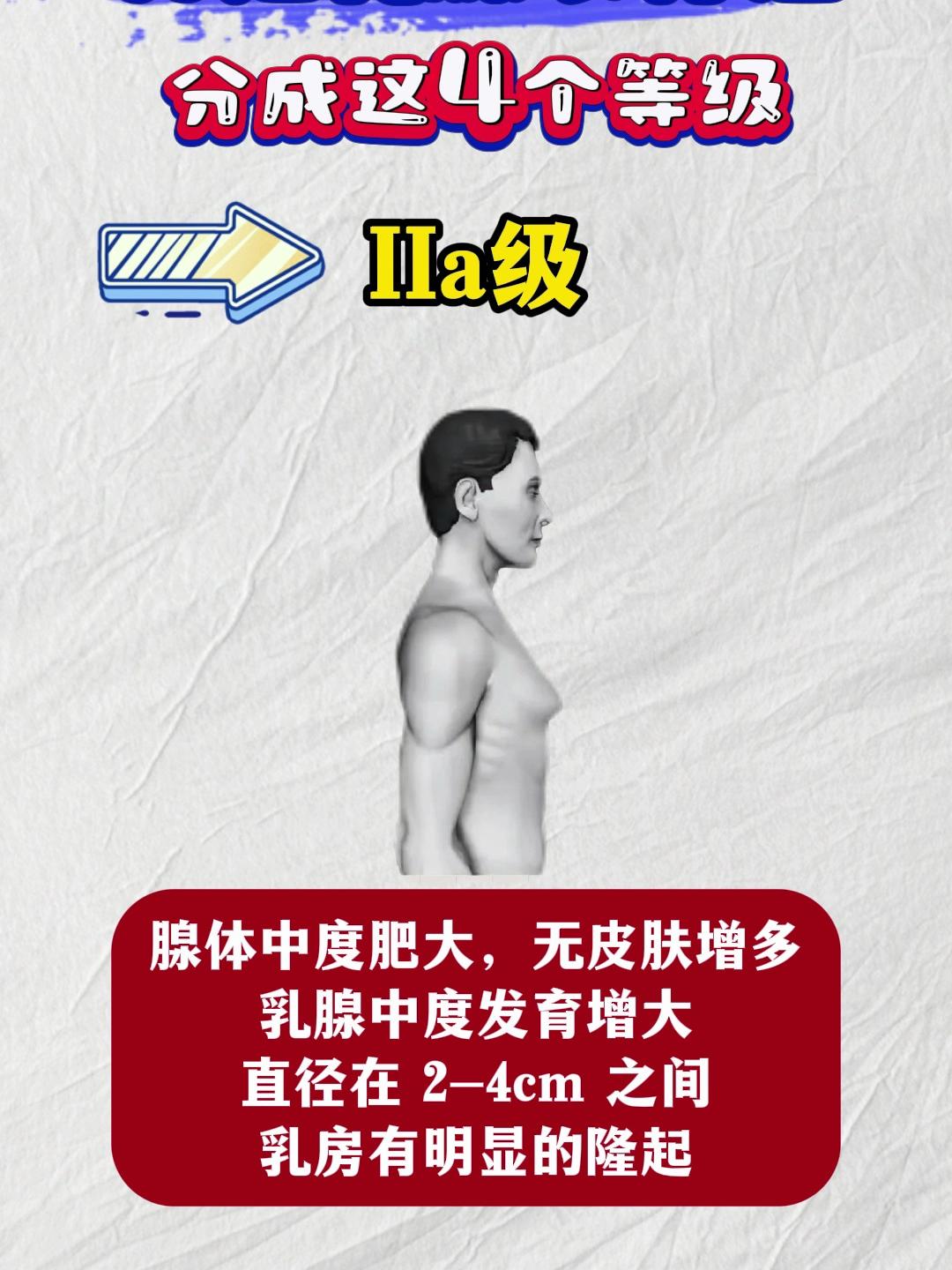 男人胸疼乳房发育图片