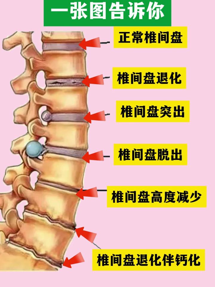 椎间盘病变一张图告诉你