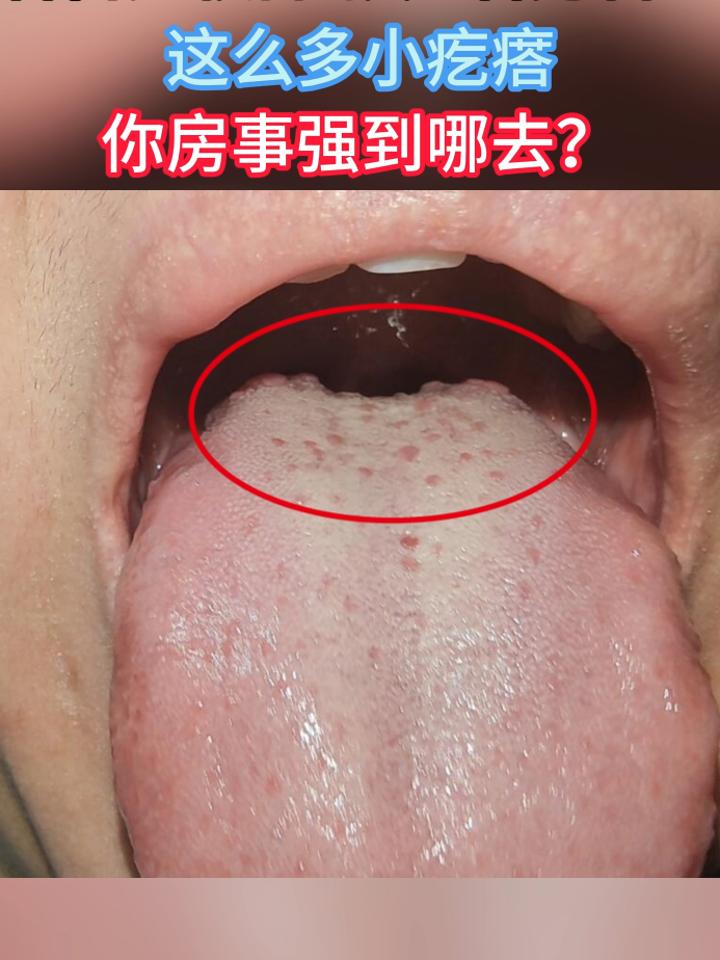 石舌头根部就是看男科 这么多小疙痞