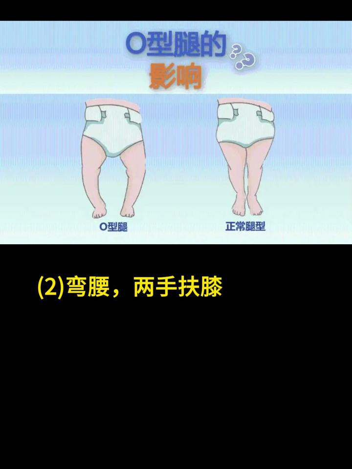 o型腿挂号什么科(o型腿去看什么科室)