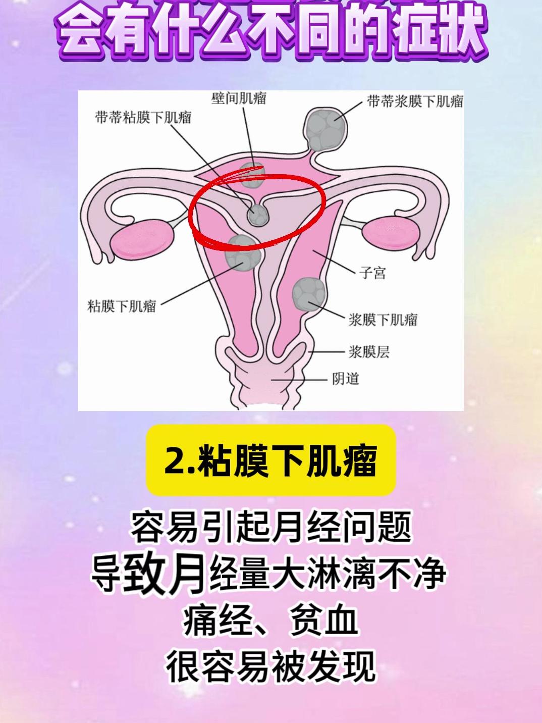 子宫肌瘤长哪里会有什么不同的症状