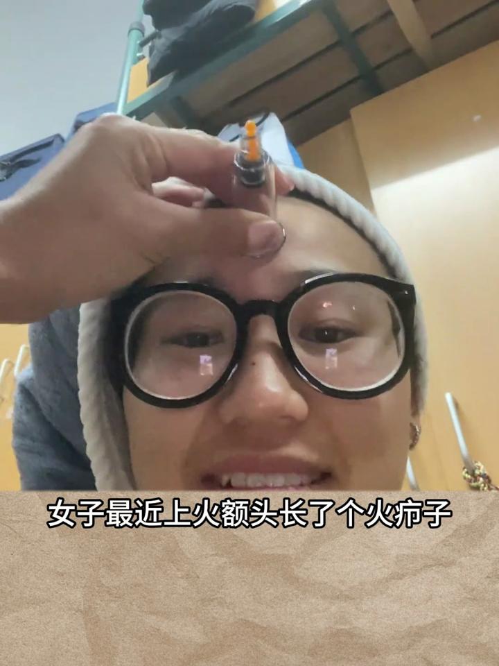 女子头上长了个火疖子,舍友利用拔罐给她拔出来