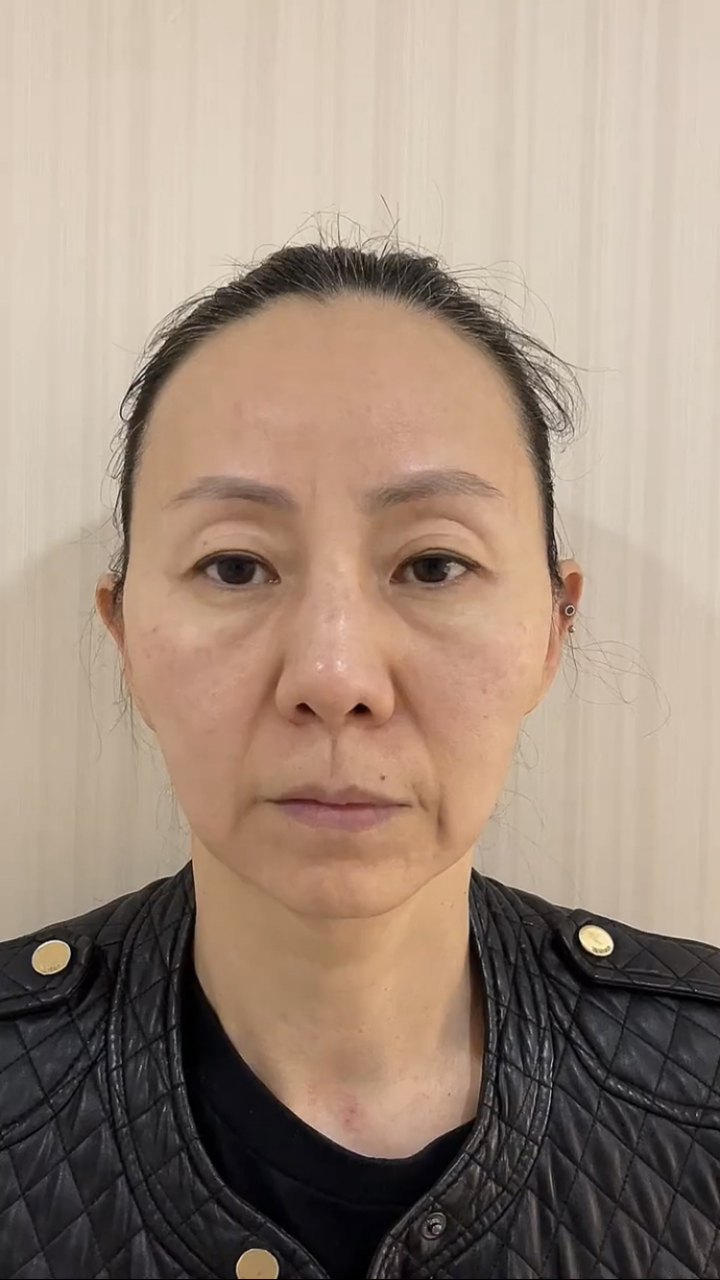 导致嘴角下垂,轮廓模糊,整个人显老态  方案设计:苹果肌复位77泪沟