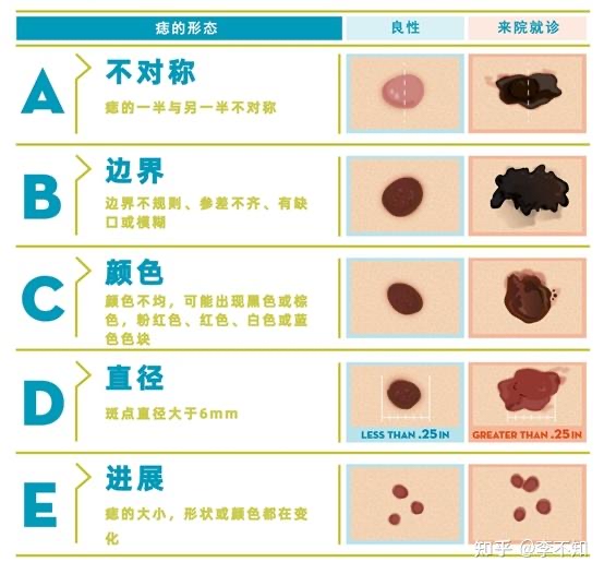 揭秘黑色素瘤 认识症状