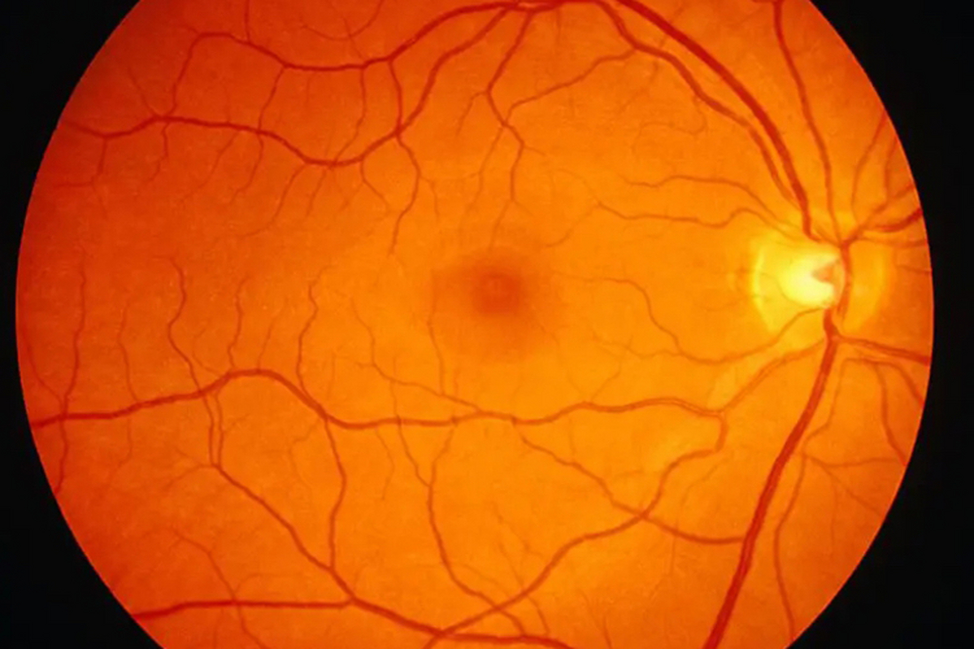 高度近视不仅影响眼睛外观,因眼轴延长,造成眼球凸出,还会发生眼球壁