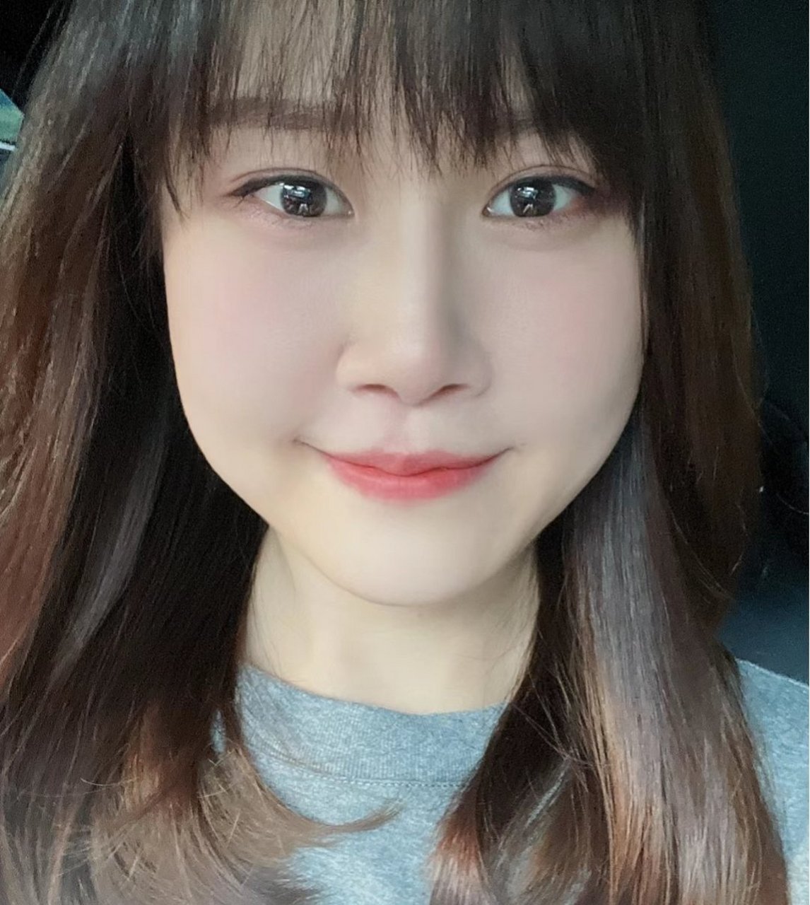 甲亢好了! 细看眼睛对比图