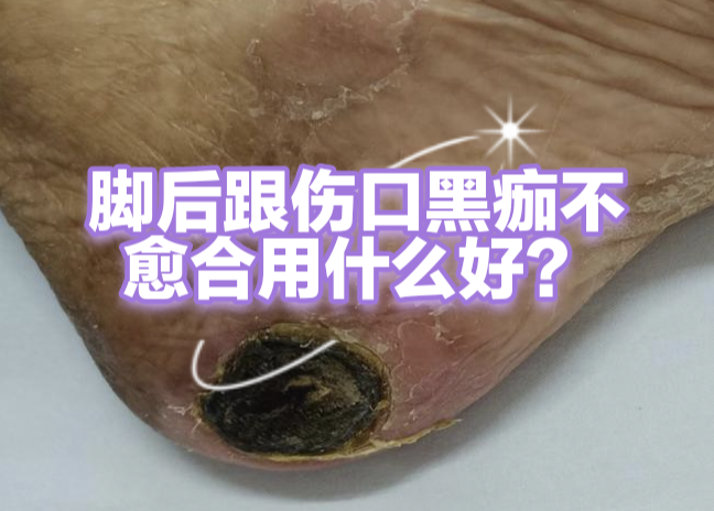 腳後跟傷口不癒合有什麼好辦法