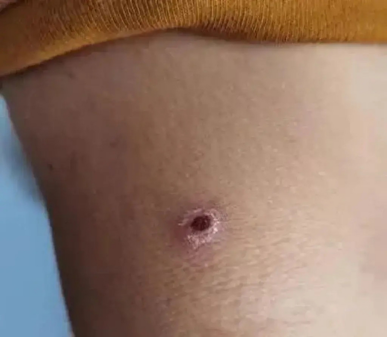 春季恙虫病高发需警惕  恙虫病是一种由恙虫病东方体引起的急性自然疫