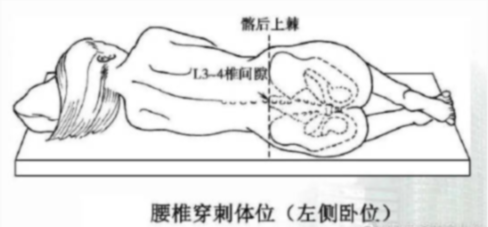 顺产打无痛分娩针图解图片