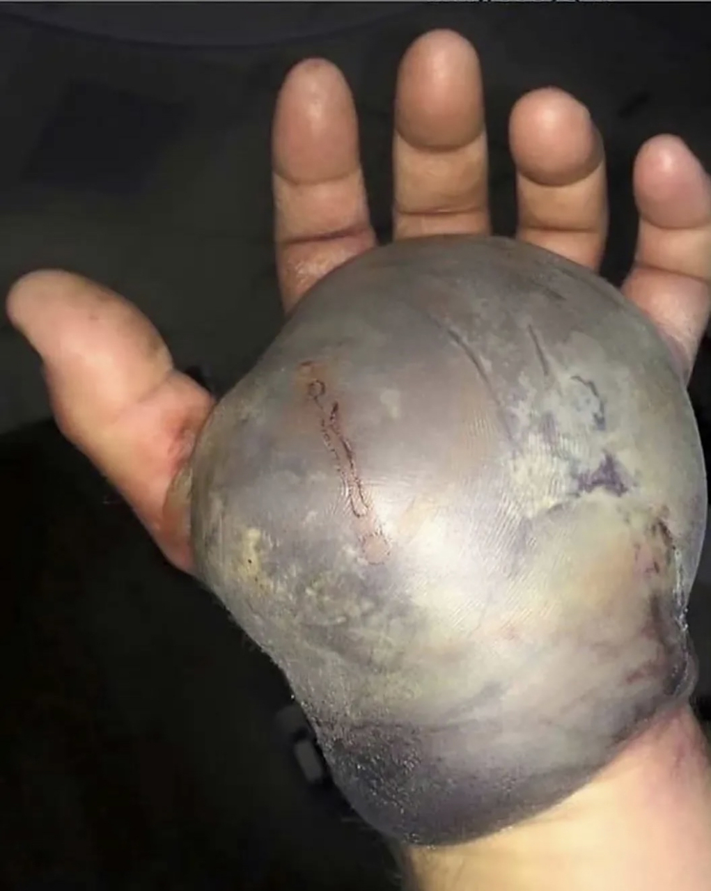 被响尾蛇咬了一口的手[悲伤]人还能活吗?