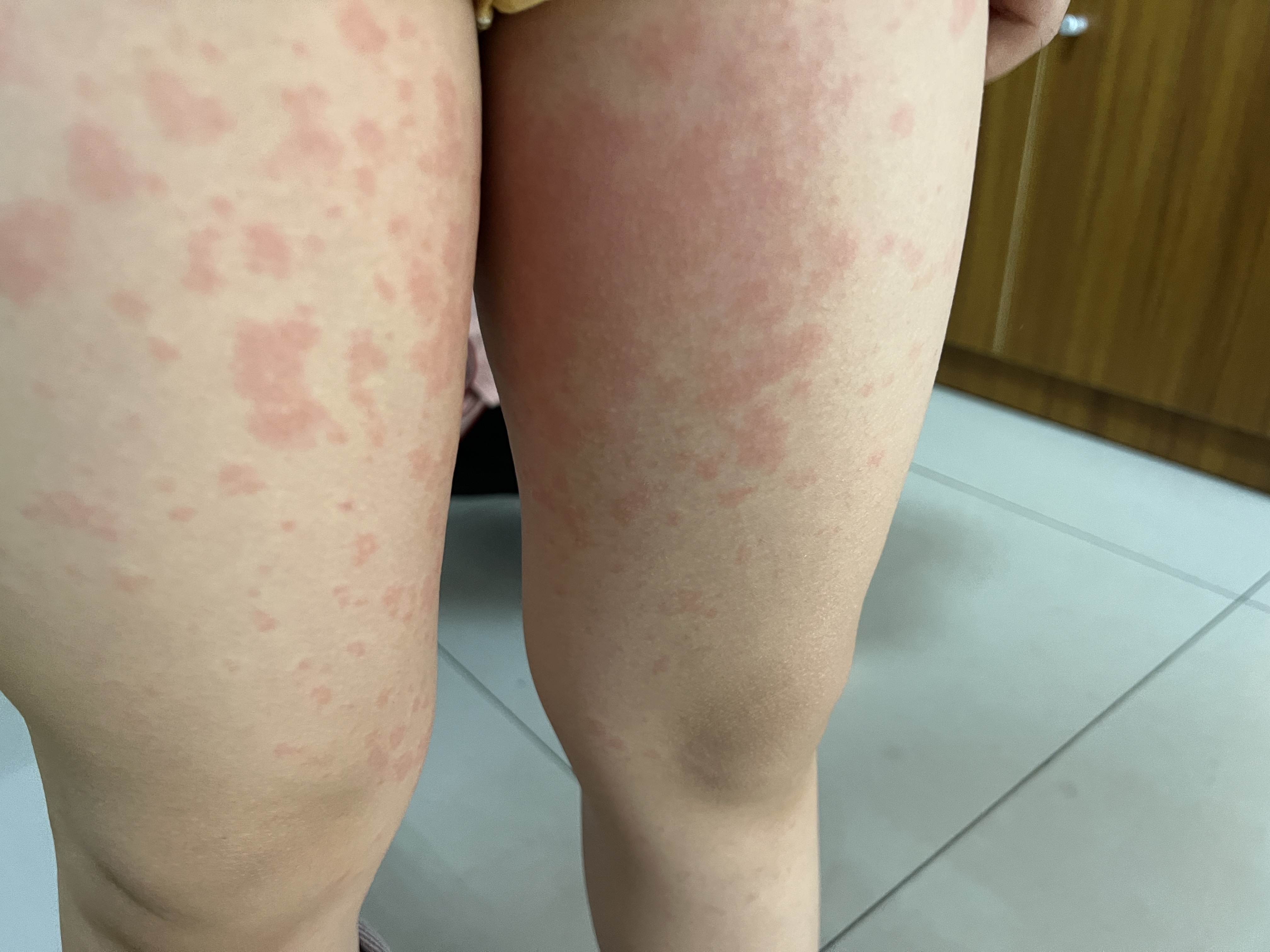 孩子腿上突然出来大片大片红斑,这是咋回事儿呢,求解