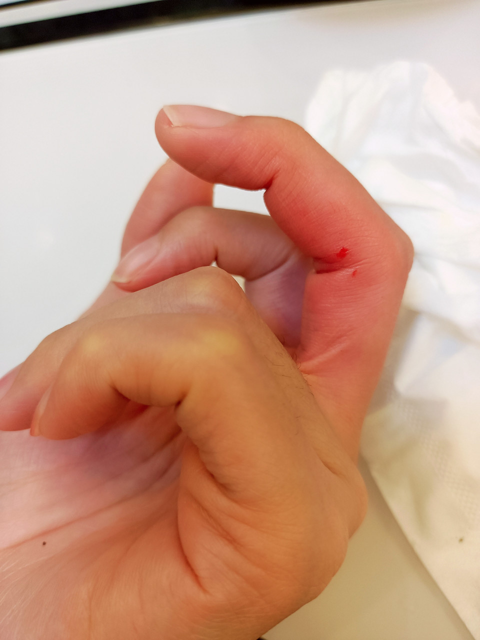 被咬了之后又痛又痒,还肿了,手指都变硬了,怎么办?