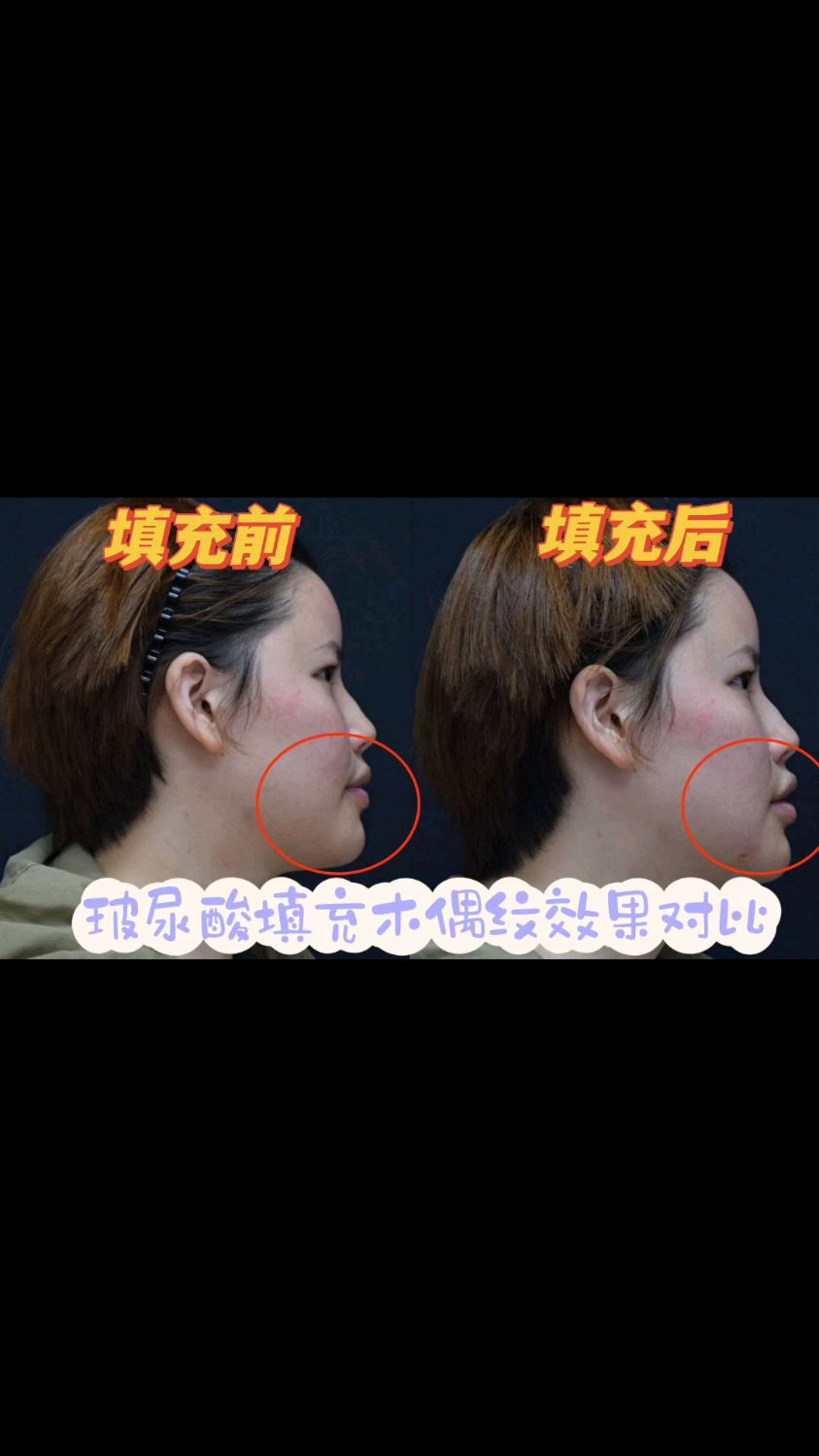 玻尿酸填充木偶纹体验分享