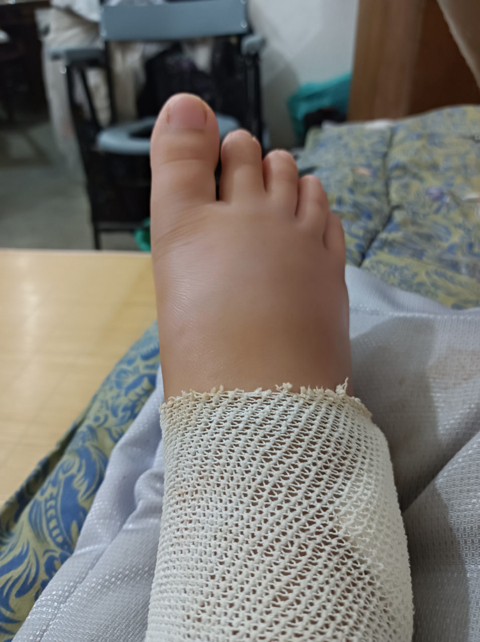 现在已经回到家有两天了,但是我的脚还是肿的,缝合的伤口,已经结痂了