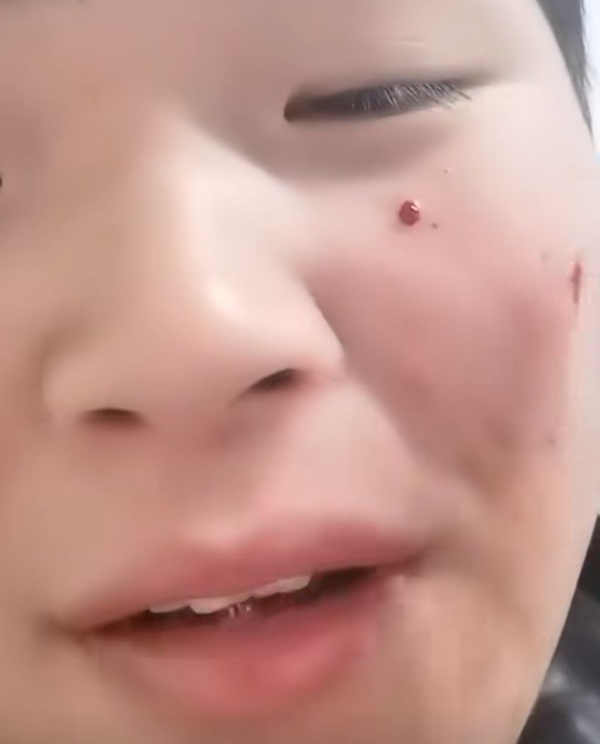 四川男生抠掉脸部痘痘,血流不止,用了400张抽纸才止住!
