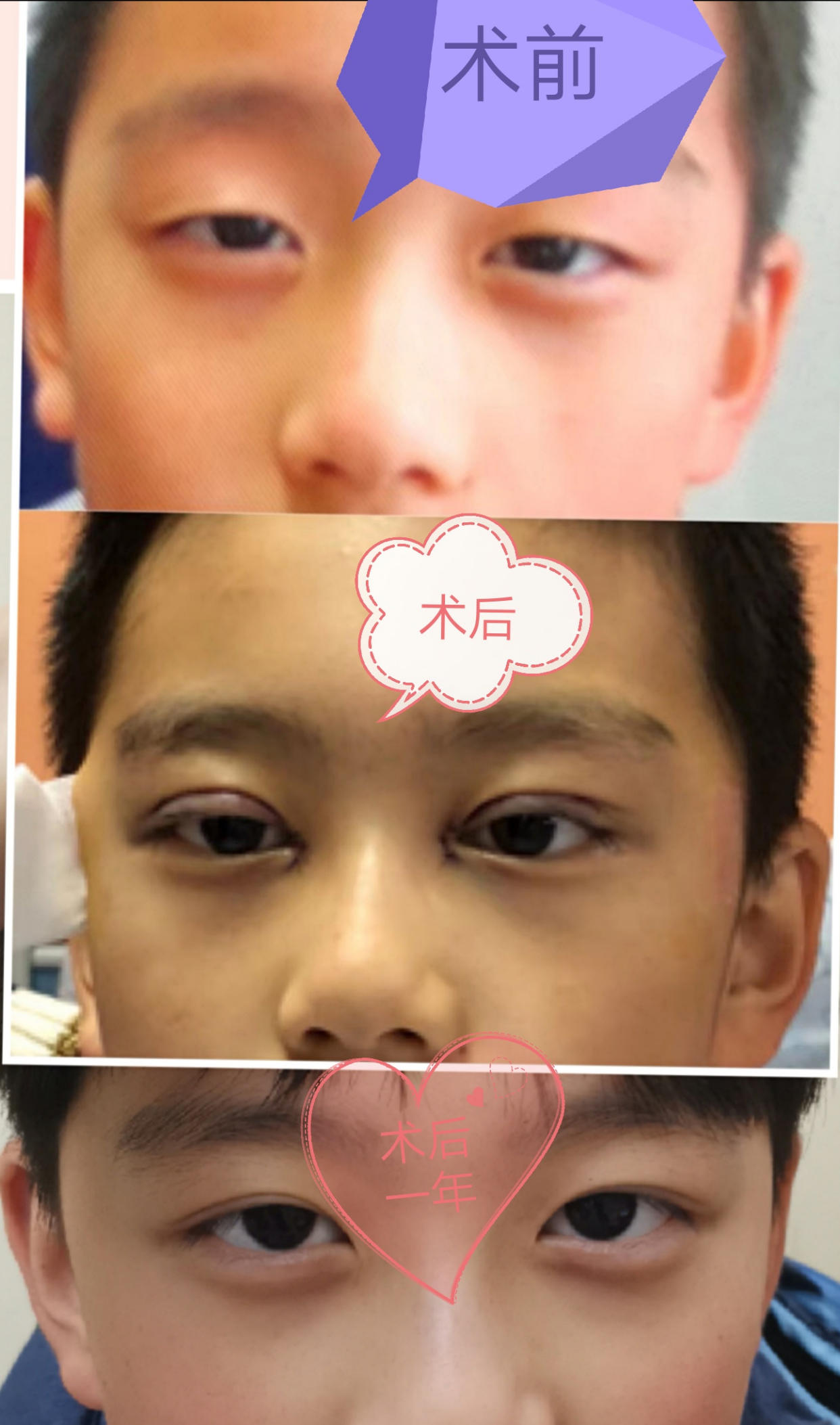 先天性睑内翻倒睫手术案例分享