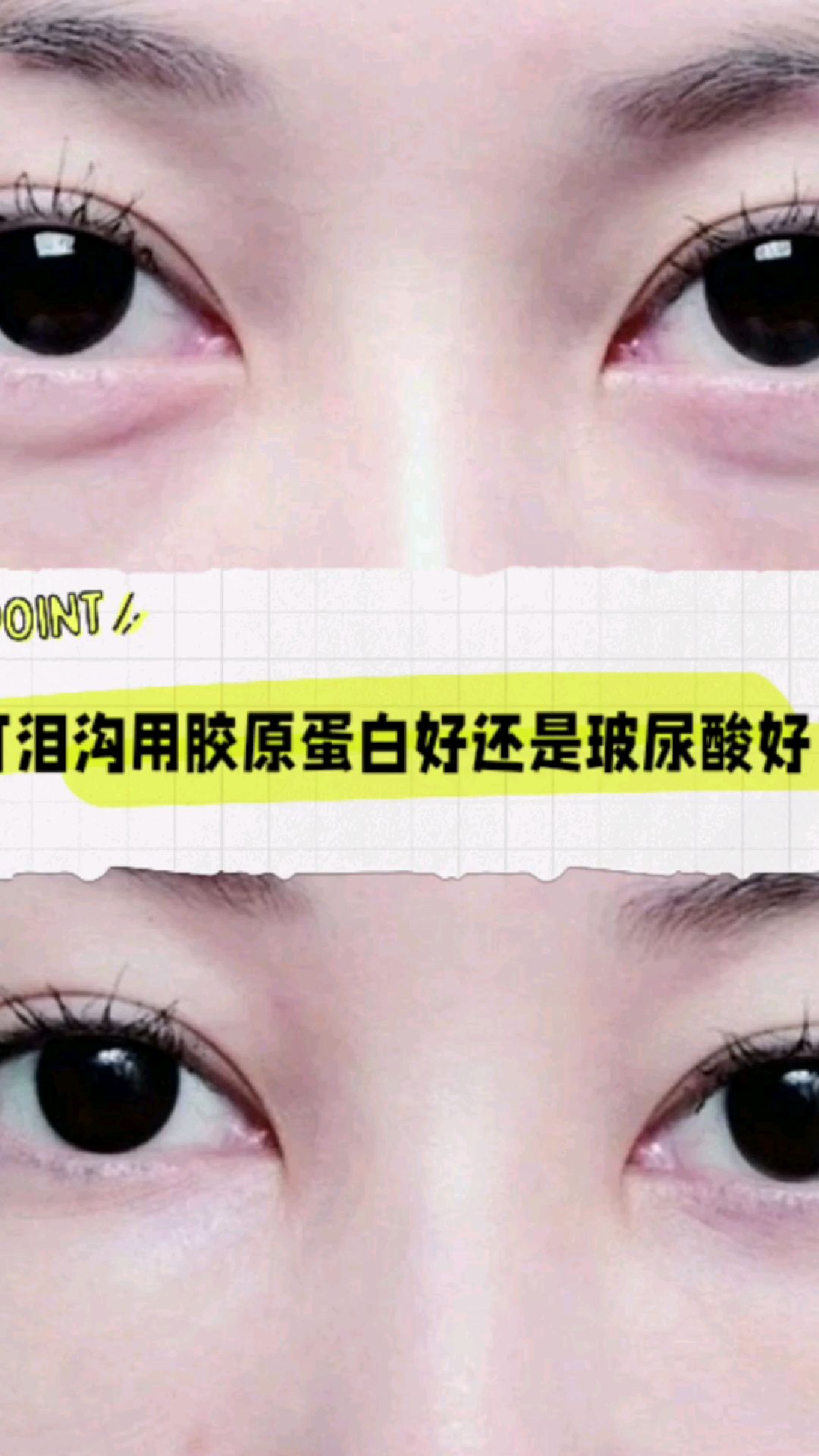 打泪沟用胶原蛋白好还是玻尿酸好?#暑你最美