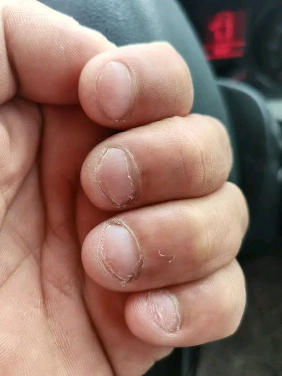 总是忍不住咬指甲怎么办?