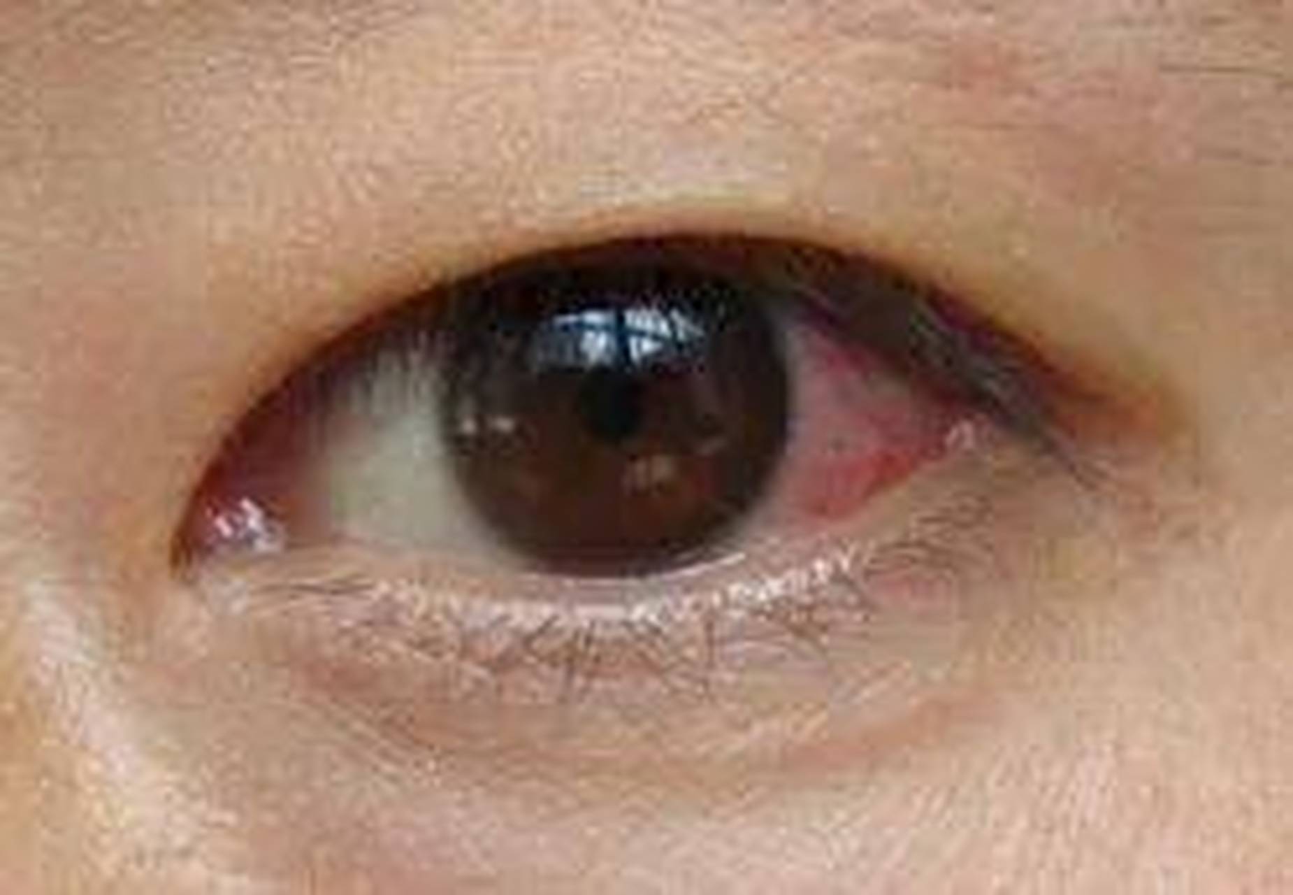 1.16,据悉,国内已检测出多例,患者有结膜炎症状.