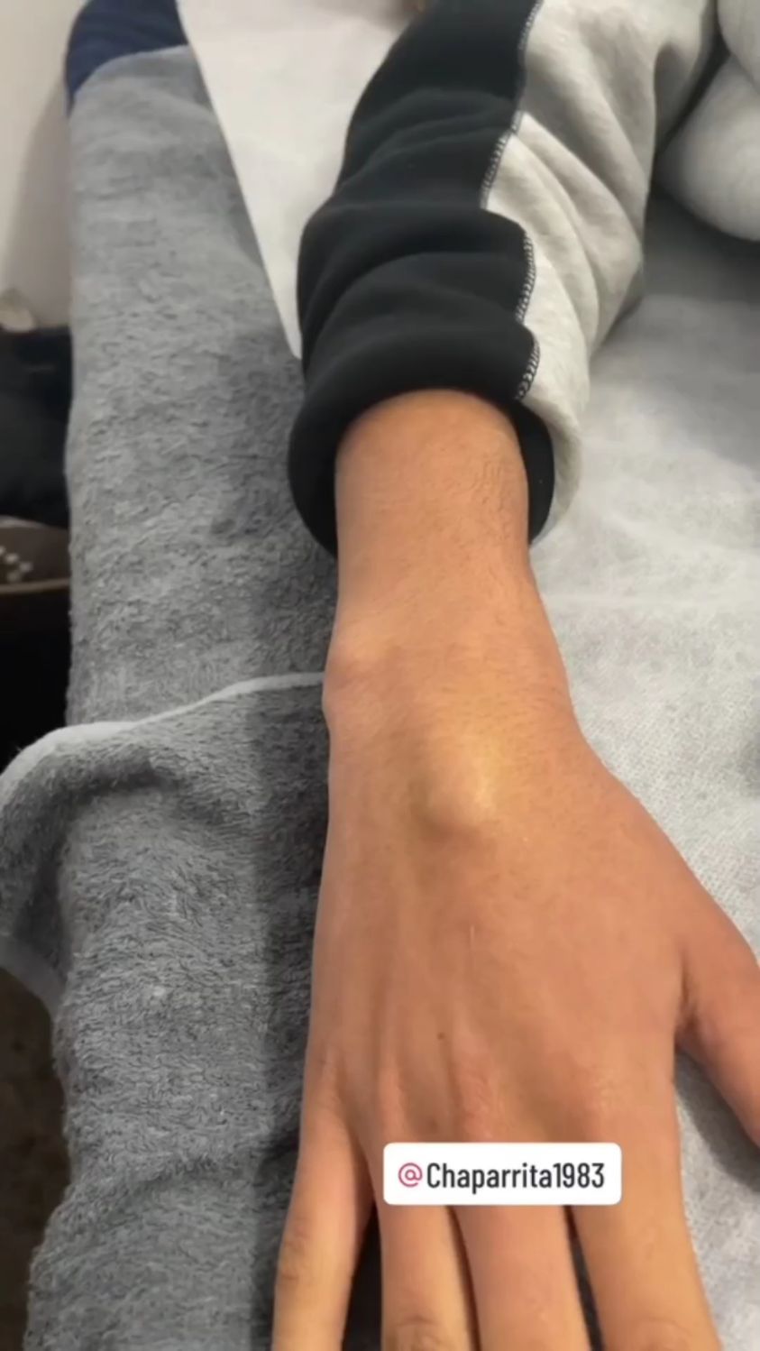 这个筋包要想治好,只能揉开它,不过得老疼了